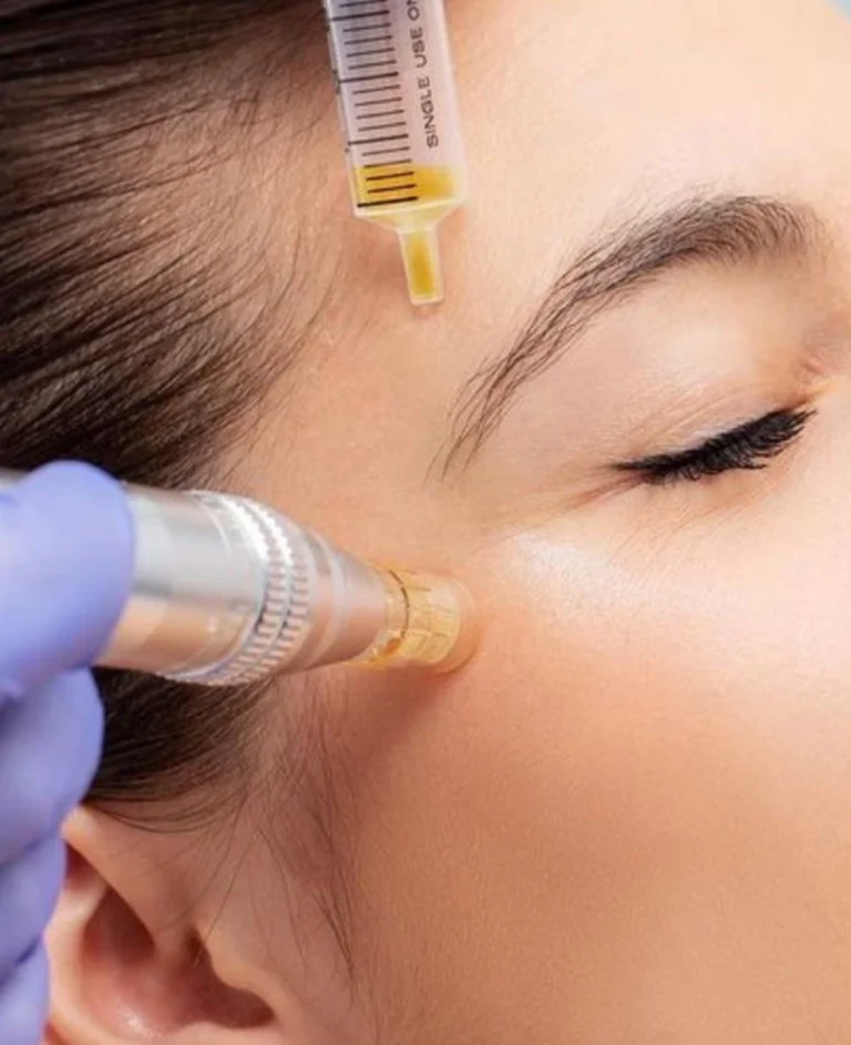 microneedling with PRF