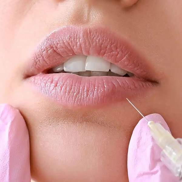 Lip Filler2