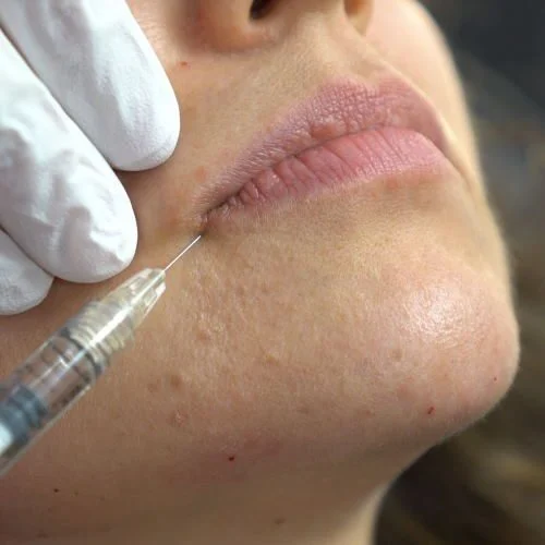 Lip Filler4